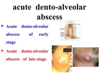 acute dento-alveolar
abscess
 Acute dento-alveolar
abscess of early
stage
 Acute dento-alveolar
abscess of late stage
 