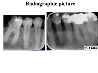 Radiographic picture
 