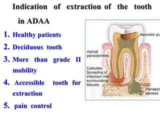 Indication of extraction of the tooth
in ADAA
1. Healthy patients
2. Deciduous tooth
3. More than grade II
mobility
4. Accessible tooth for
extraction
5. pain control
 