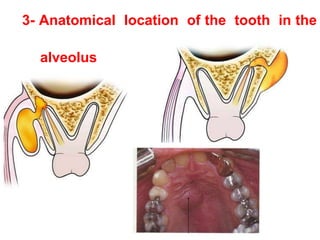3- Anatomical location of the tooth in the
alveolus
 