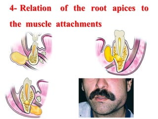 4- Relation of the root apices to
the muscle attachments
 
