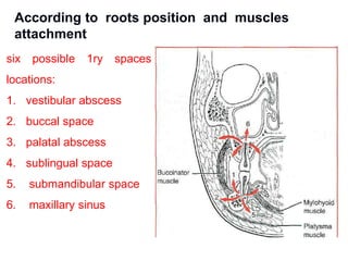 six possible 1ry spaces
locations:
1. vestibular abscess
2. buccal space
3. palatal abscess
4. sublingual space
5. submandibular space
6. maxillary sinus
According to roots position and muscles
attachment
 