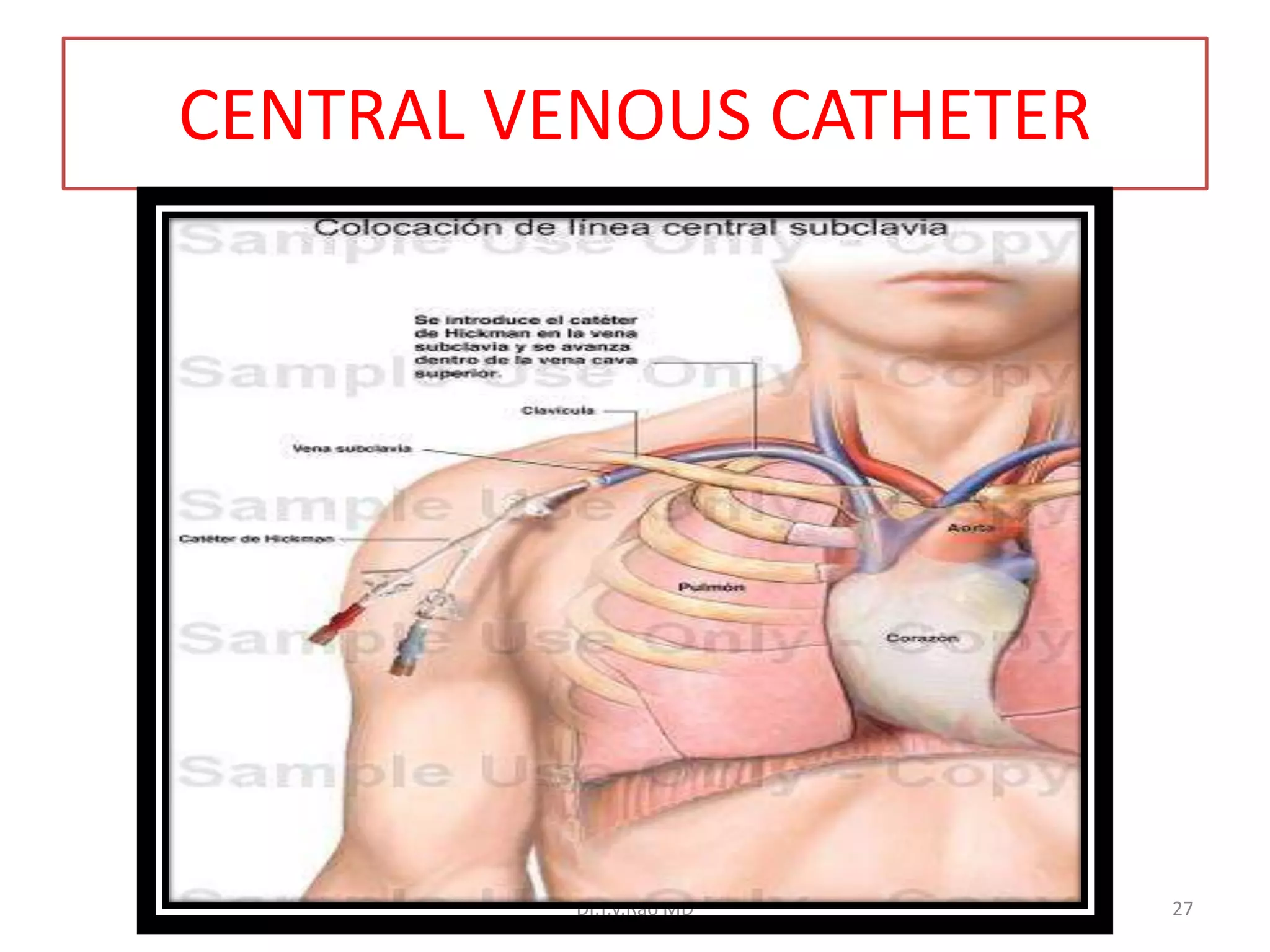 CENTRAL VENOUS CATHETER
Dr.T.V.Rao MD 27
 