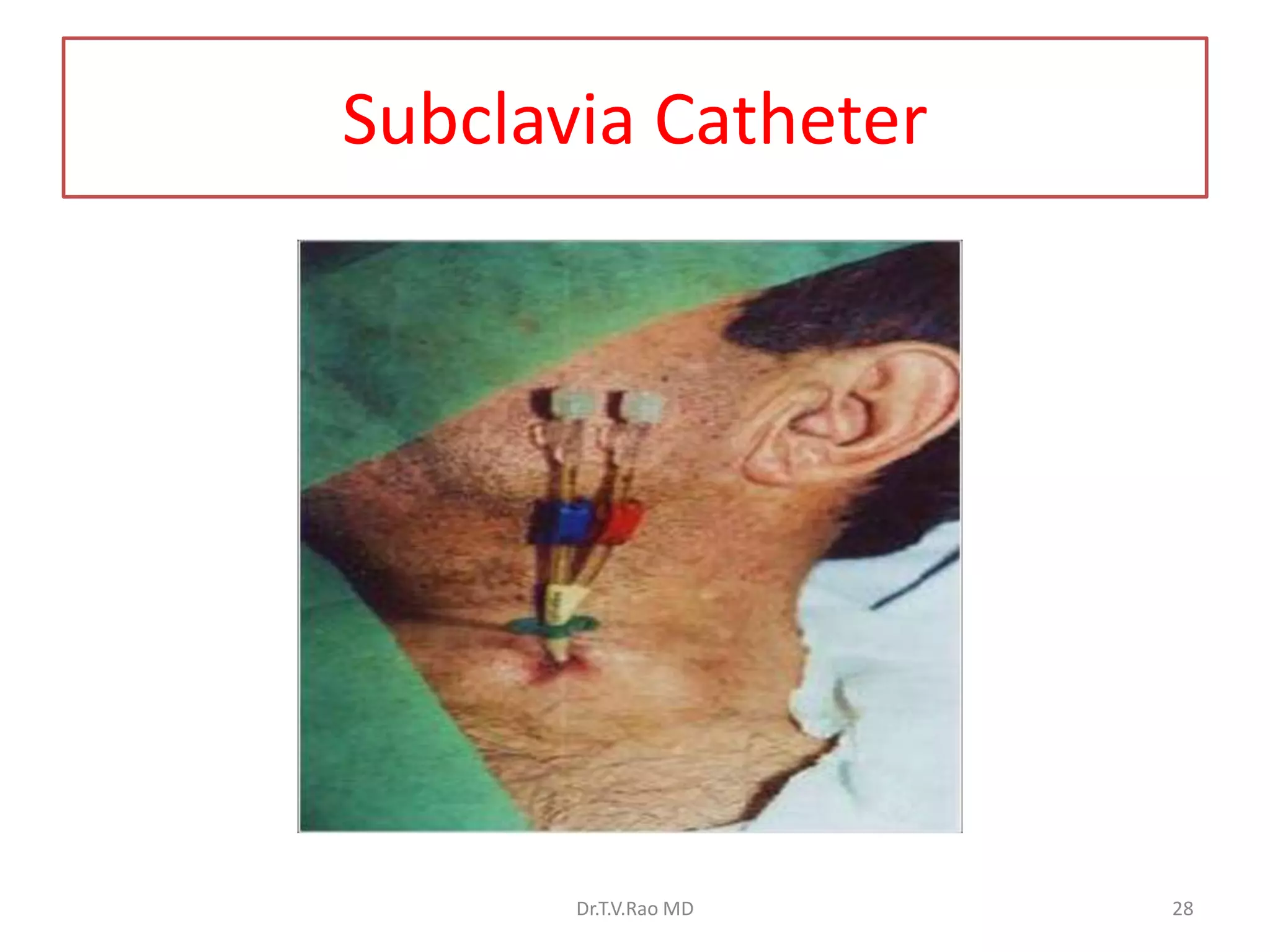 Subclavia Catheter
Dr.T.V.Rao MD 28
 