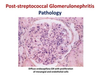 Post-streptococcal Glomerulonephritis 
Management 
 