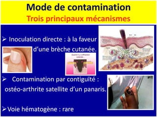 Mode de contamination
Trois principaux mécanismes
 Inoculation directe : à la faveur
d’une brèche cutanée.
 Contamination par contiguïté :
ostéo-arthrite satellite d’un panaris.
Voie hématogène : rare
 