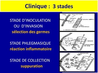 Clinique : 3 stades
STADE D’INOCULATION
OU D’INVASION
sélection des germes
STADE PHLEGMASIQUE
réaction inflammatoire
STADE DE COLLECTION
suppuration
 