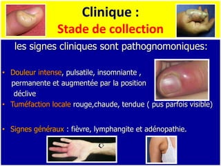 Clinique :
Stade de collection
les signes cliniques sont pathognomoniques:
• Douleur intense, pulsatile, insomniante ,
permanente et augmentée par la position
déclive
• Tuméfaction locale rouge,chaude, tendue ( pus parfois visible)
• Signes généraux : fièvre, lymphangite et adénopathie.
 
