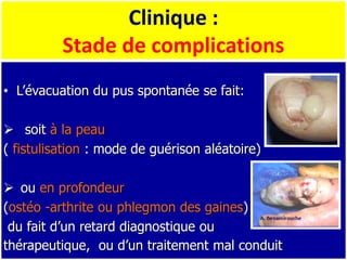 Clinique :
Stade de complications
• L’évacuation du pus spontanée se fait:
 soit à la peau
( fistulisation : mode de guérison aléatoire)
 ou en profondeur
(ostéo -arthrite ou phlegmon des gaines)
du fait d’un retard diagnostique ou
thérapeutique, ou d’un traitement mal conduit
 
