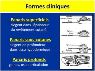 Formes cliniques
Panaris superficiels
siègent dans l’épaisseur
du revêtement cutané.
Panaris sous-cutanés
siègent en profondeur
dans tissu hypodermique
Panaris profonds
gaines, os et articulation
 