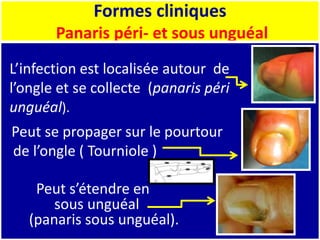 Formes cliniques
Panaris péri- et sous unguéal
Peut s’étendre en
sous unguéal
(panaris sous unguéal).
L’infection est localisée autour de
l’ongle et se collecte (panaris péri
unguéal).
Peut se propager sur le pourtour
de l’ongle ( Tourniole )
 