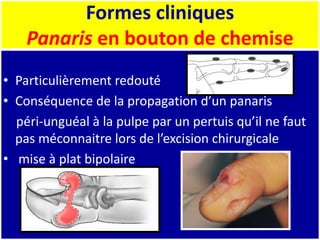 Formes cliniques
Panaris en bouton de chemise
• Particulièrement redouté
• Conséquence de la propagation d’un panaris
péri-unguéal à la pulpe par un pertuis qu’il ne faut
pas méconnaitre lors de l’excision chirurgicale
• mise à plat bipolaire
 