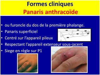 Formes cliniques
Panaris anthracoïde
• ou furoncle du dos de la première phalange.
• Panaris superficiel
• Centré sur l’appareil pileux
• Respectant l’appareil extenseur sous-jacent
• Siege en règle sur P1
 
