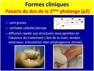 Formes cliniques
Panaris du dos de la 2ème phalange (p2)
– sont graves
– véritable cellulite dorsale
– diffusion rapide aux structures sous-jacentes en
l’absence de traitement ( dos de la main, tendon
extenseur, articulation inter phalangienne distale).
 