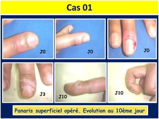 Cas 01
Panaris superficiel opéré. Evolution au 10ème jour
J0 J0 J0
J3 J10
J10
 