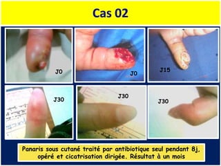 Cas 02
Panaris sous cutané traité par antibiotique seul pendant 8j,
opéré et cicatrisation dirigée. Résultat à un mois
J0 J0
J15
J30
J30
J30
 