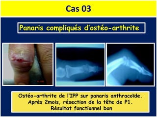 Cas 03
Panaris compliqués d’ostéo-arthrite
Ostéo-arthrite de l’IPP sur panaris anthracoïde.
Après 2mois, résection de la tête de P1.
Résultat fonctionnel bon
 