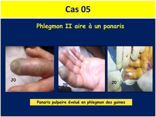 Cas 05
Phlegmon II aire à un panaris
Panaris pulpaire évolué en phlegmon des gaines
J0
J0
J0
 
