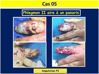 Cas 05
Phlegmon II aire à un panaris
J5 J5
Amputation P3
J5
J5
 