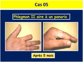 Cas 05
Phlegmon II aire à un panaris
Après 5 mois
 