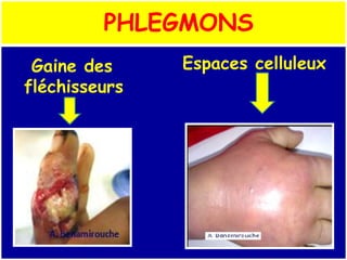 PHLEGMONS
Gaine des
fléchisseurs
Espaces celluleux
 