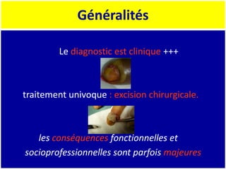Généralités
Le diagnostic est clinique +++
traitement univoque : excision chirurgicale.
les conséquences fonctionnelles et
socioprofessionnelles sont parfois majeures
 
