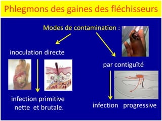 inoculation directe
Phlegmons des gaines des fléchisseurs
par contiguïté
infection progressive
infection primitive
nette et brutale.
Modes de contamination :
 