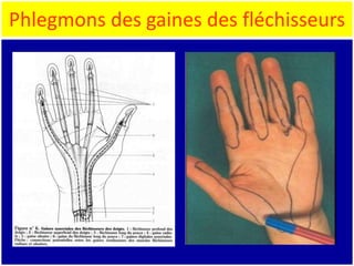 Phlegmons des gaines des fléchisseurs
 