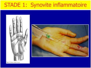 STADE 1: Synovite inflammatoire
 