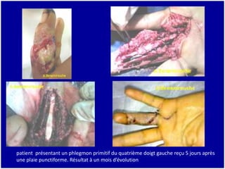 patient présentant un phlegmon primitif du quatrième doigt gauche reçu 5 jours après
une plaie punctiforme. Résultat à un mois d’évolution
 