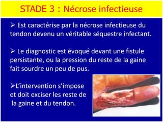 STADE 3 : Nécrose infectieuse
 Est caractérise par la nécrose infectieuse du
tendon devenu un véritable séquestre infectant.
 Le diagnostic est évoqué devant une fistule
persistante, ou la pression du reste de la gaine
fait sourdre un peu de pus.
L’intervention s’impose
et doit exciser les reste de
la gaine et du tendon.
 