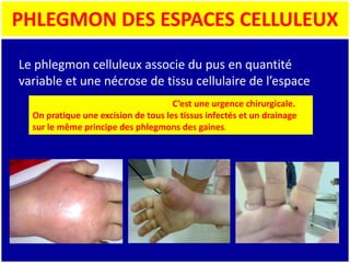 PHLEGMON DES ESPACES CELLULEUX
Le phlegmon celluleux associe du pus en quantité
variable et une nécrose de tissu cellulaire de l’espace
C’est une urgence chirurgicale.
On pratique une excision de tous les tissus infectés et un drainage
sur le même principe des phlegmons des gaines.
 