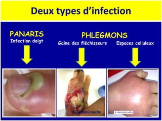 Deux types d’infection
PANARIS
Infection doigt
PHLEGMONS
Gaine des fléchisseurs Espaces celluleux
 