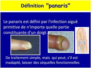 Définition "panaris"
Le panaris est défini par l'infection aiguë
primitive de n'importe quelle partie
constituante d'un doigt.
De traitement simple, mais qui peut, s’il est
inadapté, laisser des séquelles fonctionnelles.
 