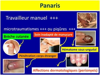 Panaris
Travailleur manuel +++
microtraumatismes +++ ou piqûres +++
Brèche cutanée
Soin inadapté de manucure
Pénétration corps étranger
Hématome sous-unguéal
Affections dermatologiques (perionyxis)
 