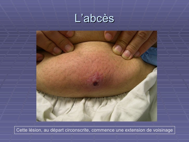 Infections locales en chirurgie
