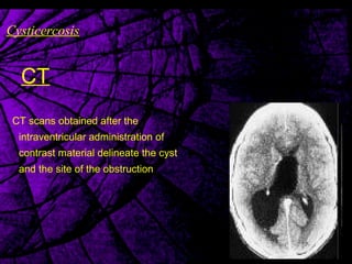 Cysticercosis
CT
CT scans obtained after the
intraventricular administration of
contrast material delineate the cyst
and the site of the obstruction
 