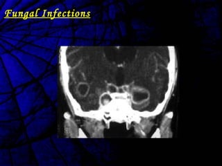 Fungal Infections
 