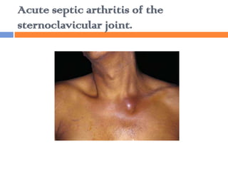 Acute septic arthritis of the
sternoclavicular joint.
 