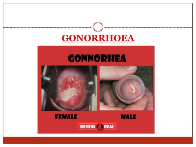 rectal gonorrhea symptoms rectal gonorrhea symptoms
