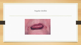 Oral mucosa fungal infections.pdf. lecture oral medicine | PDF