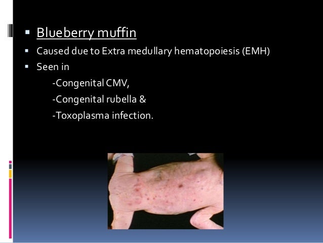 Dermatological Infections In Newborn Dr Padmesh dermatological-infections-in-newborn-dr-padmesh
