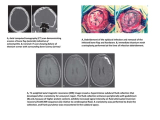 A, Axial computed tomography (CT) scan demonstrating
erosion of bone flap (asterisk) indicative of
osteomyelitis. B, Coronal CT scan showing failure of
titanium screws with surrounding bone lucency (arrow)
A, Debridement of the epidural infection and removal of the
infected bone flap and hardware. B, Immediate titanium mesh
cranioplasty performed at the time of infection debridement.
A, T1-weighted axial magnetic resonance (MR) image reveals a hyperintense subdural fluid collection that
developed after craniotomy for aneurysm repair. The fluid collection enhances peripherally with gadolinium
(B) and, because of higher protein content, exhibits increased signal intensity on fluid-attenuated inversion
recovery (FLAIR) MR sequences (C) relative to cerebrospinal fluid. A craniotomy was performed to drain the
collection, and frank purulence was encountered in the subdural space.
 