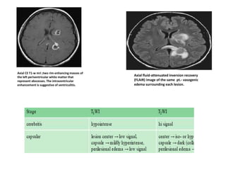 Axial CE T1-w mri ;two rim-enhancing masses of
the left periventricular white matter that
represent abscesses. The intraventricular
enhancement is suggestive of ventriculitis.
Axial fluid-attenuated inversion recovery
(FLAIR) image of the same pt.- vasogenic
edema surrounding each lesion.
 