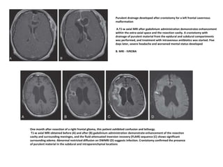 Purulent drainage developed after craniotomy for a left frontal cavernous
malformation
A.T1-w axial MRI after gadolinium administration demonstrates enhancement
within the extra-axial space and the resection cavity. A craniotomy with
drainage of purulent material from the epidural and subdural compartments
was performed, and treatment with intravenous antibiotics was started. Five
days later, severe headache and worsened mental status developed
B. MRI - IVROBA
One month after resection of a right frontal glioma, this patient exhibited confusion and lethargy.
T1-w axial MRI obtained before (A) and after (B) gadolinium administration demonstrate enhancement of the resection
cavity and surrounding meninges, and the fluid-attenuated inversion recovery (FLAIR) sequence (C) shows significant
surrounding edema. Abnormal restricted diffusion on DWMRI (D) suggests infection. Craniotomy confirmed the presence
of purulent material in the subdural and intraparenchymal locations
 