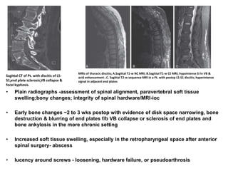 Sagittal CT of Pt. with discitis of L5-
S1;end plate sclerosis,VB collapse &
focal kyphosis.
MRIs of thoracic discitis; A.Sagittal T1-w NC MRI; B.Sagittal T1-w CE MRI; hypointense SI in VB &
avid enhancement ; C. Sagittal T2-w sequence MRI in a Pt. with postop L5-S1 discitis; hyperintense
signal in adjacent end plates
• Plain radiographs -assessment of spinal alignment, paravertebral soft tissue
swelling;bony changes; integrity of spinal hardware/MRI-ioc
• Early bone changes ~2 to 3 wks postop with evidence of disk space narrowing, bone
destruction & blurring of end plates f/b VB collapse or sclerosis of end plates and
bone ankylosis in the more chronic setting
• Increased soft tissue swelling, especially in the retropharyngeal space after anterior
spinal surgery- abscess
• lucency around screws - loosening, hardware failure, or pseudoarthrosis
 