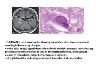 • FLAIR MRI is most sensitive for showing areas of cerebral involvement and
resulting inflammatory changes.
• In this axial image, hyperintensity is visible in the right temporal lobe affecting
the uncus and insular cortex as well as the subfrontal cortex. Although not
present in this patient, foci of hemorrhage are common.
•microglial nodules and cytoplasmic and intranuclear inclusion bodies
 
