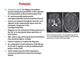 Protozoa
 Toxoplasma gondii c/b obligate intracellular
parasite Toxoplasma gondii/MC in HIV/ ingestion
of contaminated cat feces/undercooked meat
• CF: rash/myocarditis/polymyositis;
meningoencephalitis (seizures/confusion/coma)
• Lesions are scattered throughout the brain, and
adjacent to the subarachnoid space cause the
meningitis component of the
meningoencephalitis
• Diagnosis can be achieved by finding organisms in
the CSF or in stereotactic biopsy specimens of
brain lesions.
• MRI :solid to ring enhancing lesions/combination;
/any location/single or multiple
• Positive response to medical Rx-diagnostic
 Rx: combination of pyrimethamine (100-200 mg
D1 f/b 50-75 mg/day x 6 wks) & sulfadiazine(4-6
g/day x 6 wks)- DOC
 Folinic acid/Leucovorin (10-25 mg/day) to
prevent pyrimethamine-induced hematologic
toxicity
HIV Pt. with seizures & CSF + for toxoplasma Ag; T2-w &
T1-w CE of cerebral hemispheres (A & B) ; ring-enhancing
lesion with an eccentric enhancing nodule
 