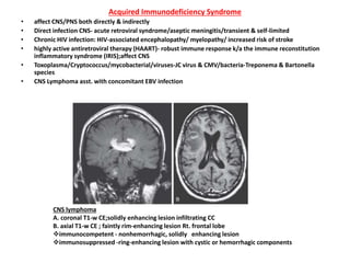 Acquired Immunodeficiency Syndrome
• affect CNS/PNS both directly & indirectly
• Direct infection CNS- acute retroviral syndrome/aseptic meningitis/transient & self-limited
• Chronic HIV infection: HIV-associated encephalopathy/ myelopathy/ increased risk of stroke
• highly active antiretroviral therapy (HAART)- robust immune response k/a the immune reconstitution
inflammatory syndrome (IRIS);affect CNS
• Toxoplasma/Cryptococcus/mycobacterial/viruses-JC virus & CMV/bacteria-Treponema & Bartonella
species
• CNS Lymphoma asst. with concomitant EBV infection
CNS lymphoma
A. coronal T1-w CE;solidly enhancing lesion infiltrating CC
B. axial T1-w CE ; faintly rim-enhancing lesion Rt. frontal lobe
immunocompetent - nonhemorrhagic, solidly enhancing lesion
immunosuppressed -ring-enhancing lesion with cystic or hemorrhagic components
 
