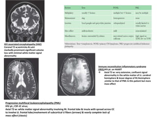 HIV associated encephalopathy (HAE)
Coronal T2 w;ventricles & sulci
markedly prominent-significant volume
loss with minimal white matter signal
abnormality
Progressive multifocal leukoencephalopathy (PML)
HIV pt.; CSF-JC virus;
Axial T2-w: white matter signal abnormality involving Rt. frontal lobe & insula with spread across CC
to involve Lt. frontal lobe;involvement of subcortical U fibers (arrows) & nearly complete lack of
mass effect (classic)
Immune reconstitution inflammatory syndrome
(IRIS);HIV pt. on HAART
 Axial T2-w: very extensive, confluent signal
abnormality in the white matter of Lt. cerebral
hemisphere & lesser degree of Rt.Hemisphere
;similar to that of PML In this patient but more
mass effect
 